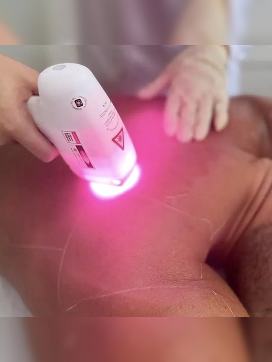 Diodenlaser-Behandlung bei Lindoju Beauty
